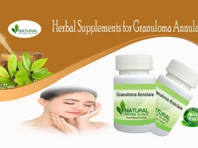 Herbal Supplement for Granuloma Annulare