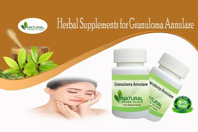 Herbal Supplement for Granuloma Annulare